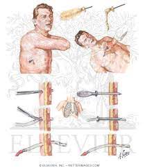 A pneumothorax is an abnormal collection of air in the pleural space between the lung and the chest wall. Treatment Of Tension Pneumothorax Insertion Of Drainage Tubes