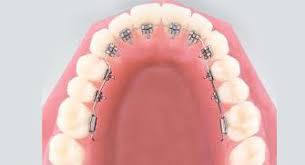 Braket Cesitleri Ortodonti Braket Dis