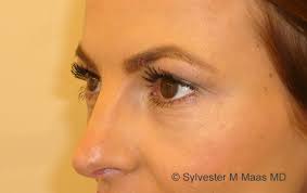 Was sind die ursachen für augenringe? Vorher Nachher Augenringe Unterspritzung Maas Aesthetics Zug Maas Aesthetics