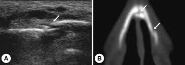 Fracture of nasal bone â€ closed reduction. Ultrasonography In The Diagnosis Of Nasal Bone Fractures A Comparison With Conventional Radiography And Computed Tomography Springerlink
