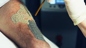 The actual level of pain of tattoo removal will vary depending on the person and their specific tattoo. All You Need To Know About Tattoo Removal