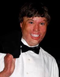 Wilton filmmaker offers emotional look at burn survivors in new documentary