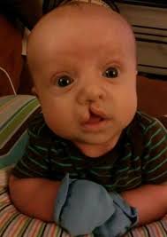 Why My Son Says He Always Wanted a Cleft