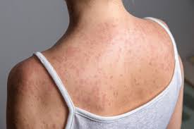 Image result for Measles