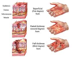 Characteristics Of Burn Injuries