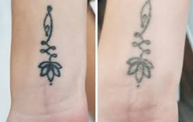 Speed up laser tattoo removal process. Laser Tattoo Removal Faq Goodbye Tattoos Neutral Bay