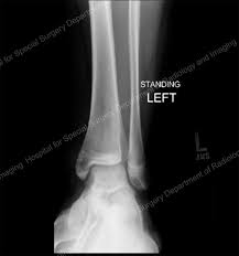 One, two, or all three malleoli can be broken. When A Child Breaks An Ankle Hss Pediatric Orthopedics
