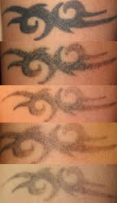 Keith is the owner and founder of tribal expression, he has been widely regarded as a professional in advanced piercings such as surface piercings, multiple. New Skin Laser Tattoo Removal Victoria Bc Tattoo Removal In Victoria British Columbia By Pete Mckay At Urge Studios