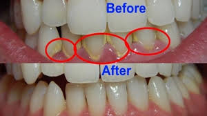 Plak gigi terbentuk saat bakteri dalam mulut bercampur dengan. Yang Perlu Diketahui Tentang Karang Gigi Dan Akibat Jika Tidak Dibersihkan Dental Id