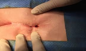 Such a cyst arises on the tailbone due to factors such as ingrown hair, accumulation of dirt and debris, etc. Pilonidal Sinus Dr Shashikant S Jadhav