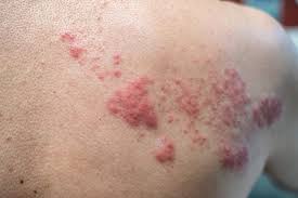 We think the rashes are coming from your immune response to the vaccine, which is why i say it's not necessarily a bad thing if you get a rash after the vaccine. The Covid 19 Vaccine Won T Give You Herpes Here S Why