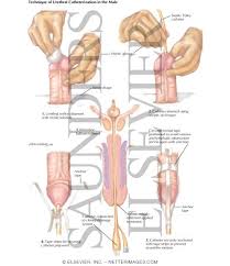 Image result for Urethral Catheterization
