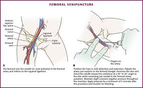 Image result for Venous Blood Sampling