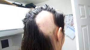 Gaya rambut botak bagian garis rambut kesalahan menyisir rambut bisa menyebabkan garis rambut semakin surut dan menipis. Calon Pengantin Perempuan Botak Gara Gara Persiapan Pernikahan Tribun Kaltim