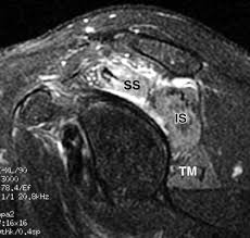 Parsonage Turner Syndrome Mr Imaging Findings And Clinical Information Of 27 Patients Radiology