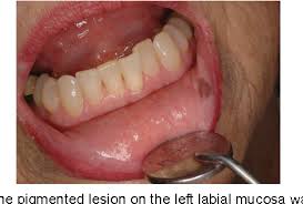Image result for Labial mucosa