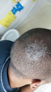 But there's another condition that causes white, brown and black spots on hair: Itchy Flaking White Spots On Scalp Dermatology Forums Patient