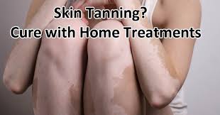 I was told it might be either (a) a skin fungus or (b) that is just the way my skin develops after tanning and possibly a lack of skin pigment. Cure White Spots On The Skin From Tanning Bed Allergy Gate
