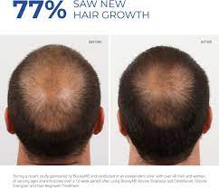 Though bosley hair products and bosley hair transplant cost is high, the success rate of close to 300,000 patients is impressive. Bosley Men S Hair Regrowth Treatment With Minoxidil Big Apple Buddy