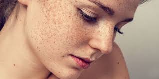 Image result for Freckled skin