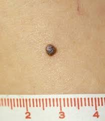 Image result for Spitz Nevus