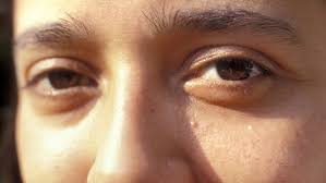 Milia Causes Treatments And Removal Of Tiny White Facial Bumps Allure Skin Bumps Forehead Acne Facial Spider Veins