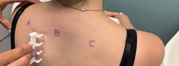 Image result for Skin Testing