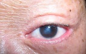 It lies in east malaysia and shares the island of borneo with the eastern state of sabah , the separate country of brunei and the indonesian provinces of kalimantan. Atlas Of Ophthalmology