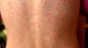 Das virus befällt und vermehrt sich in weißen blutkörperchen, den lymphozyten und in schleimhautzellen im rachen. Dreitagefieber Med Kom
