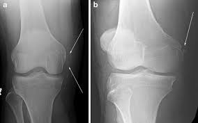 The femur (thighbone), the tibia, (shin), and the patella (kneecap). Core Curriculum Case Illustration Stieda Fracture Avulsion Fracture Of The Medial Femoral Condyle Springerlink