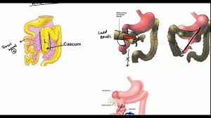 Image result for Intestinal Malrotation