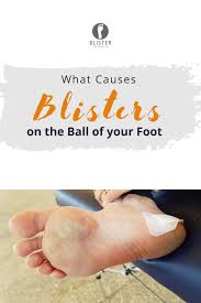 Pin On Foot Blisters