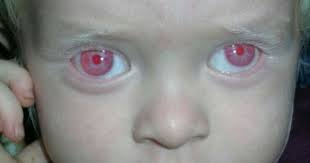 Albino Child With Red Eyes Albino Human Albino Albinism
