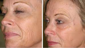 Before / after angle 1. Before And After Sculptra Subtle And Sensational Results