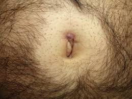 Pilonidal Sinus Cesitleri