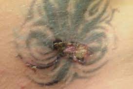 After getting a tattoo on one of your body parts, such as your chest, that requires you to remove thick hair to make the tattoo visible, you may consider using a hair removal cream. Vancouver Woman Sues Laser Clinic Over Negligence Cbc News