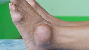 Image result for gout symptoms toe