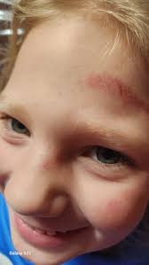 Is it normal for someone to act confused and argumentative after a fall?