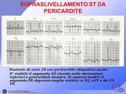 Nella pericardite acuta l'ecg mostra sopralivellamento del tratto st, generalmente a concavità superiore, nelle derivazioni con qrs positivo. Sopraslivellamento Del Segmento St Ppt Scaricare