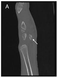 Image result for Pisiform Bone