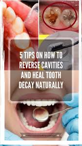 To cure tooth decay and reverse cavities you need to follow these 3 simple food steps. How To Reverse Cavities And Heal Tooth Decay Arxiusarquitectura