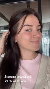 Secuencia y evolución de la aplicación de toxina botulinica BOTOX. ,  Gracias a mi linda paciente que nos visita desde Pises Bajos 🇳🇱, por  enviarme estos videos , ANDRÉS TOBAR PADILLA MD , Cirujano ...