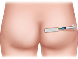 Image result for Pudendal Block