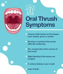 Image result for Oral thrush roof of mouth