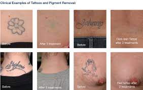 An artist may not tattoo a person younger than 18 without meeting the requirements of 25 texas administrative code, §229.406(c), whose parent or guardian determines it to be in the best interest of the minor child to cover an existing tattoo. Dallas Laser Tattoo Removal Southlake Skincare