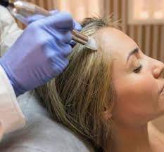 Hair Mesotherapy Treatment in Perth Australia