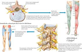 Lumbar Radiculopathy Clinical Gate