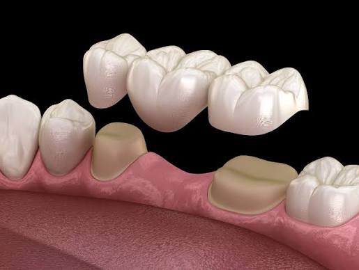 Dental Bridges in azle tx