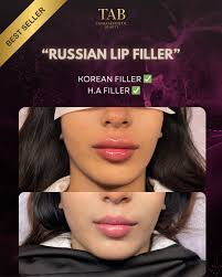 Lip Filler Tips: Migrating Filler Safely for Natural Results