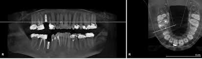 How Safe Are Dental X Rays The Healthy Mouth Project